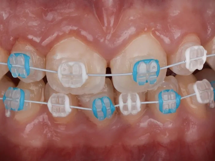 Close-up view of ceramic braces used for orthodontic treatment in Dubai.