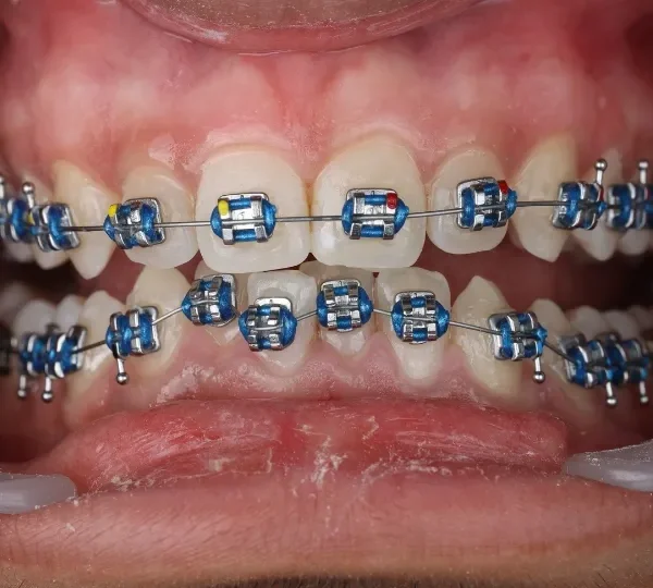 Close-up view of metal braces used for orthodontic treatment in Dubai.