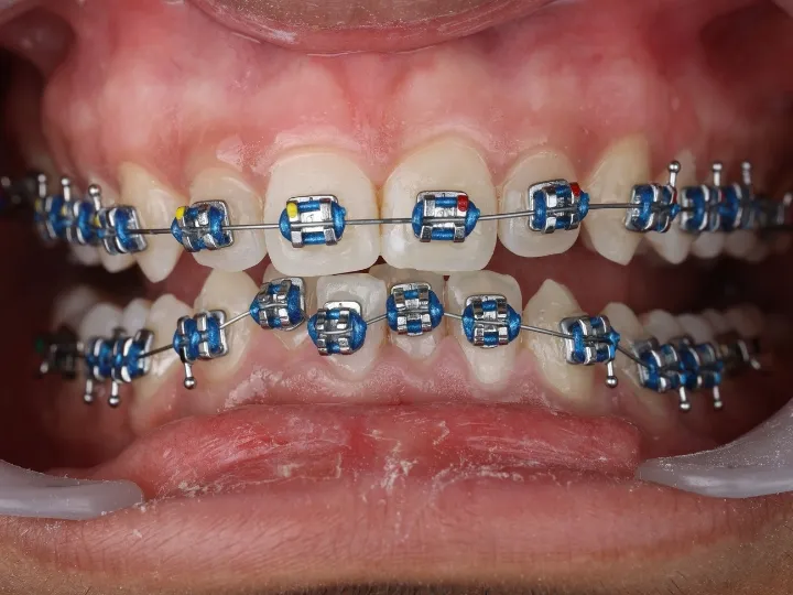 Close-up view of metal braces used for orthodontic treatment in Dubai.