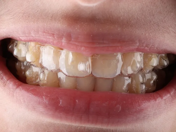 Close-up view of clear Invisalign aligners used for orthodontic treatment in Dubai.