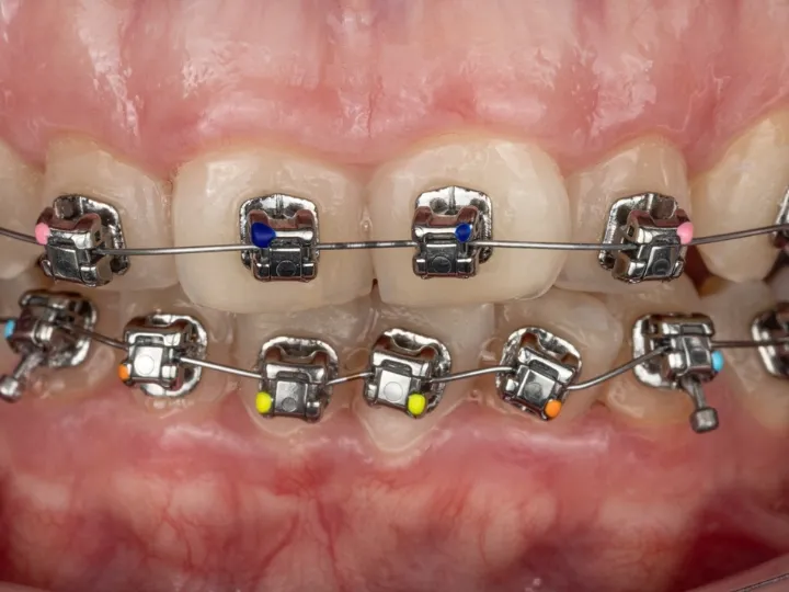 Close-up view of self-ligating metal braces used for orthodontic treatment in Dubai.