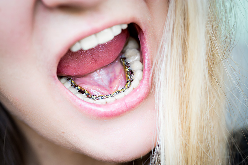 Close-up view of lingual braces applied to the back of teeth for orthodontic treatment in Dubai.