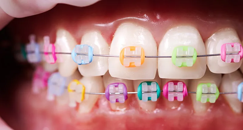Colorful braces options on a dental model showing variety of colors patients can choose from.