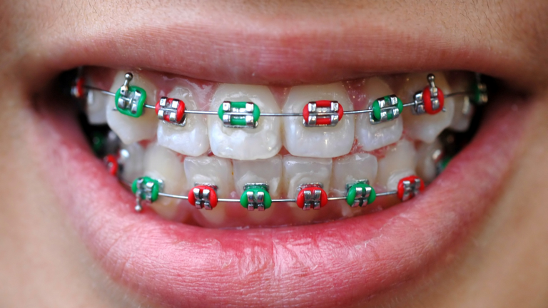 braces-colors