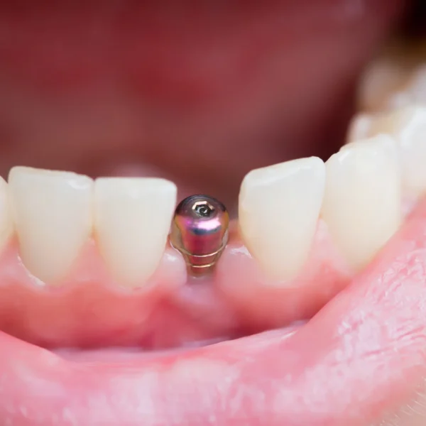 Close-up of a dental implant procedure showing realistic tooth restoration.
