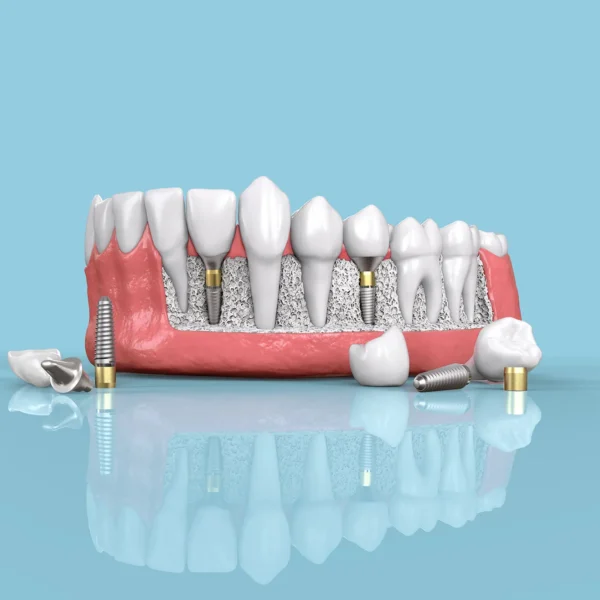 Illustration of All-on-4 dental implants showing a dental arch secured with four implants on a jawbone.