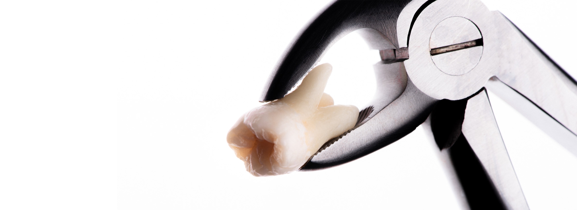 wisdom-teeth-removal