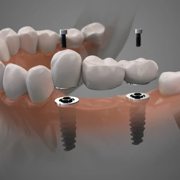 Dental implant failure causes and prevention tips explained by a dental expert.