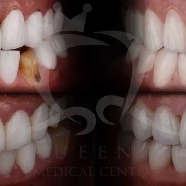 Fake vs Natural Veneers, Veneers done right