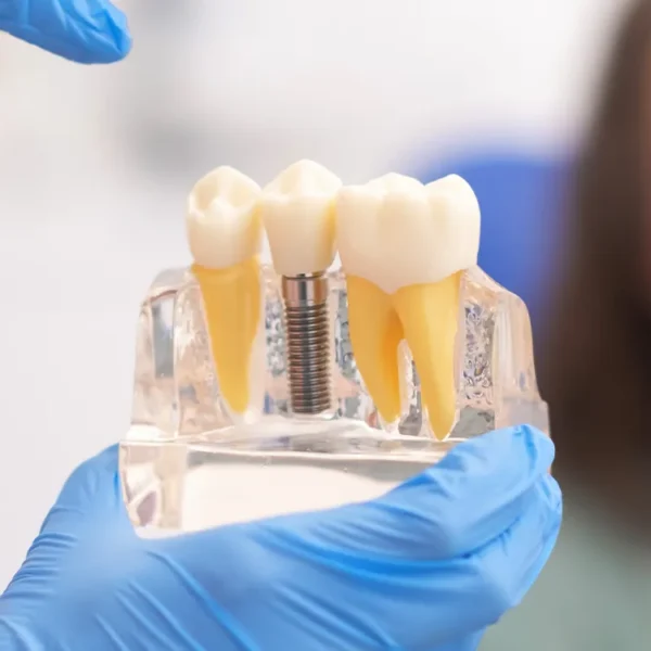 A dentist explaining the dental implant procedure to a patient, with a model of a dental implant on the table.