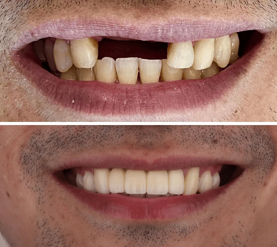 Bridge-Before-and-After-min