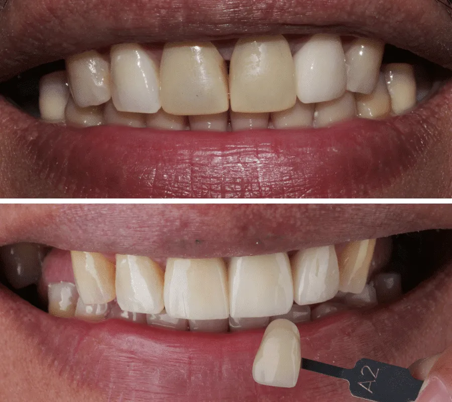 Crown-Before-and-After-min