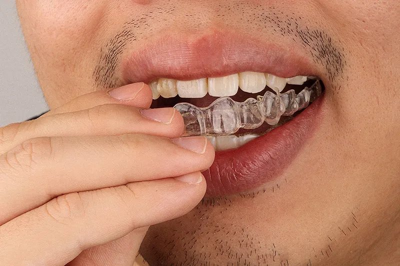 A person smiling confidently while wearing clear Invisalign aligners, showcasing the nearly invisible orthodontic treatment in a modern UAE dental clinic.