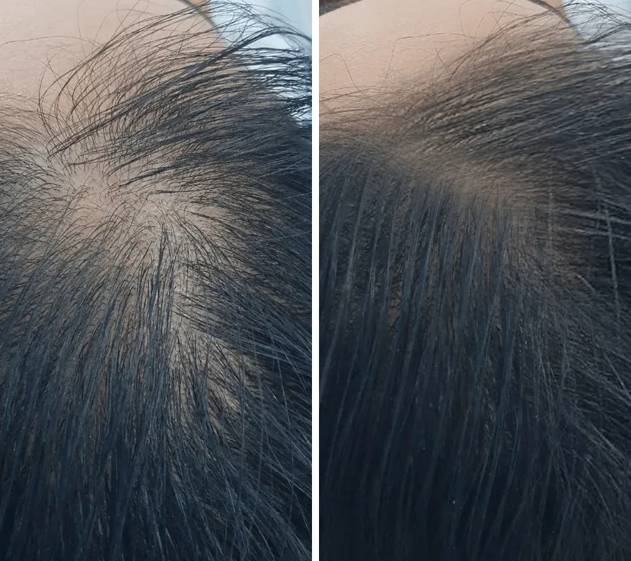 Mesotherapy-Before-and-After-min
