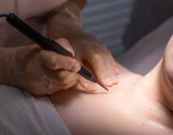 Detailed skin tag removal procedure at Queens Medical Center, Dubai