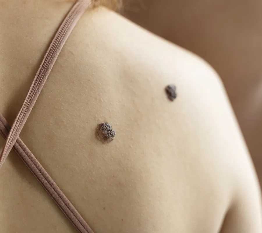 Safe and effective skin tag removal in Dubai at Queens Medical Center