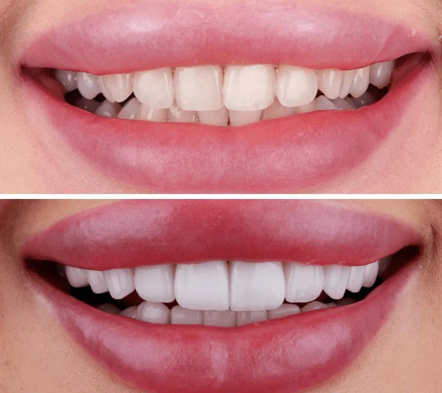 Close-up of a perfect smile enhanced with top-quality dental veneers in Dubai.