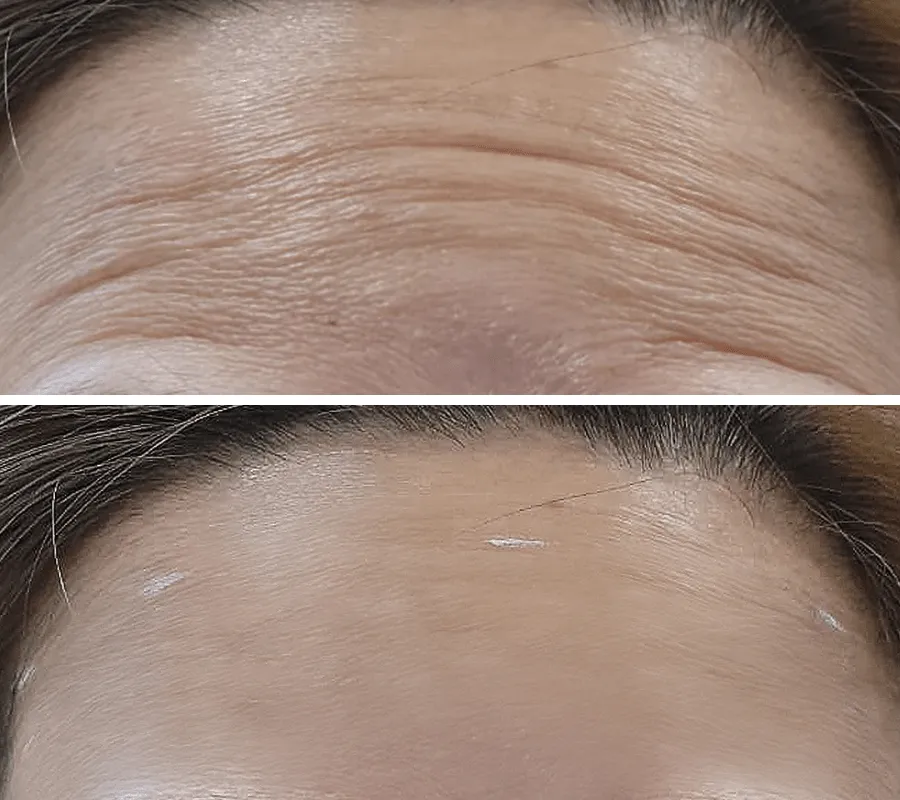 Wrinkles-Before-and-After-1