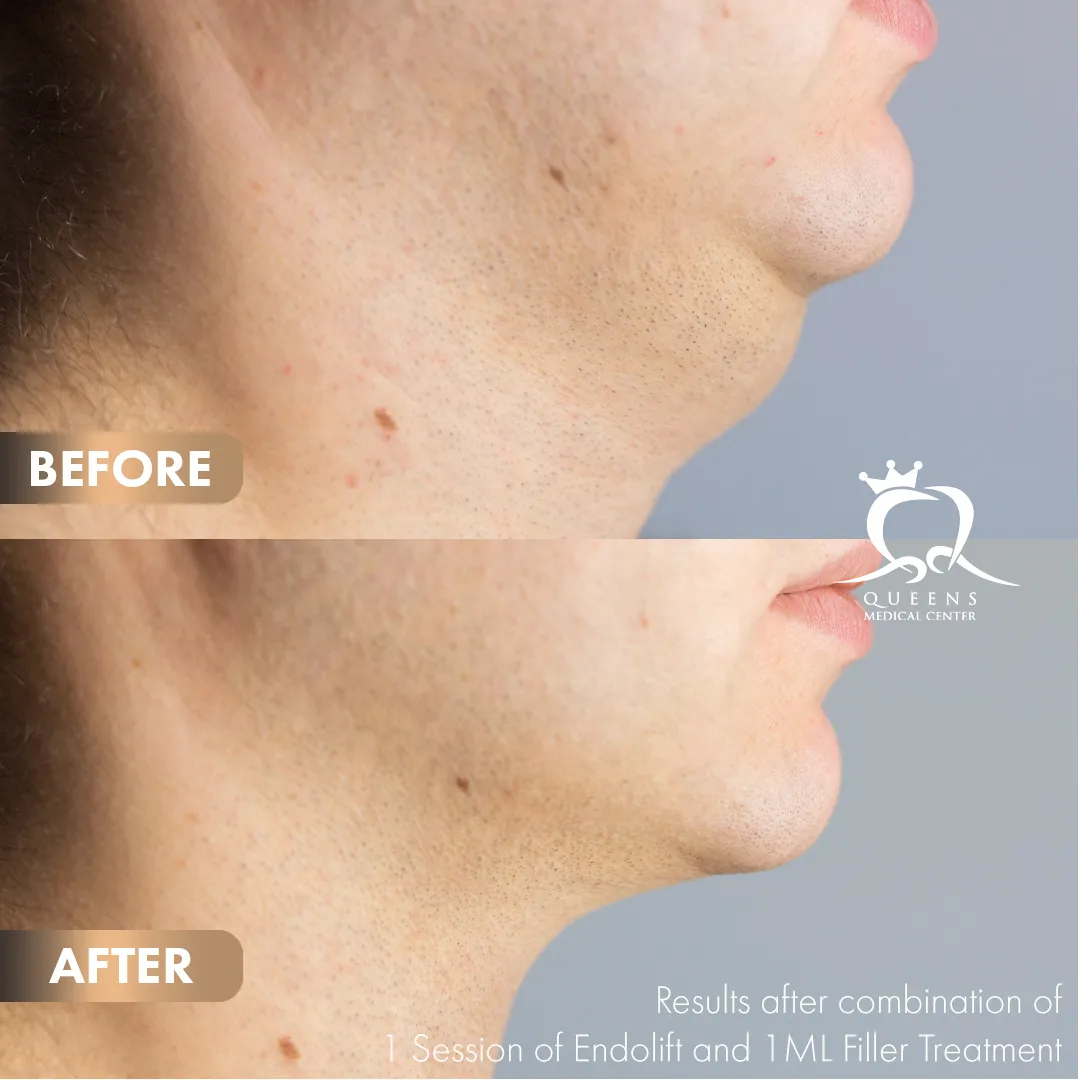 BA-Endolift and Chin Jawline Filler