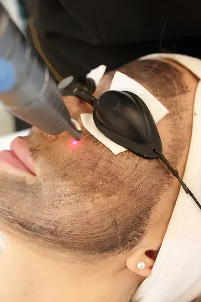 Carbon Laser Peel - 1