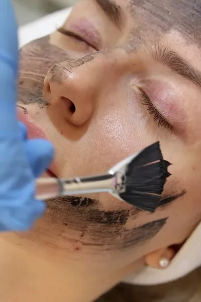 Carbon Laser Peel - 2