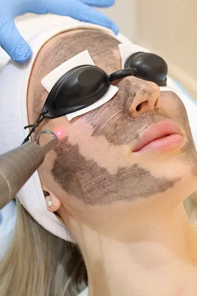 Carbon Laser Peel - 3