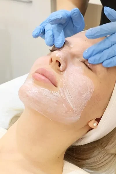 Carbon Laser Peel - 4