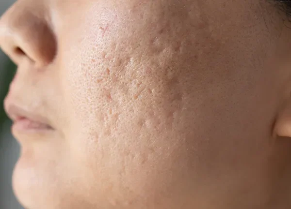 Close-up of a woman's face showing clear skin after acne scar treatment