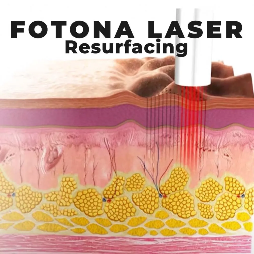 fotona laser surfacing