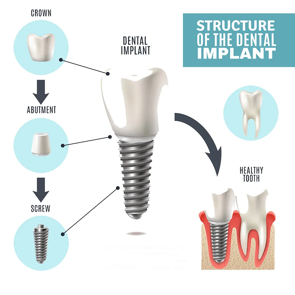 Dental Implant Structure N