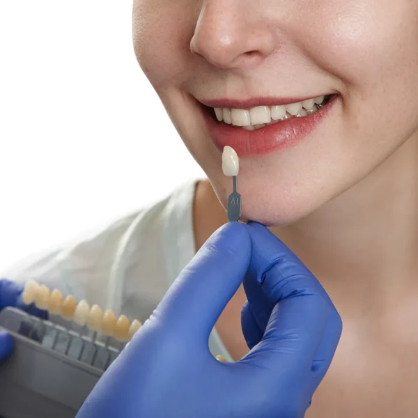 Smiling person with white composite veneers showing healthy, bright teeth after dental care.